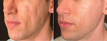 Visual showing the three main benefits of the Vellura Microinfusion System – lifting, smoothing, and glowing skin