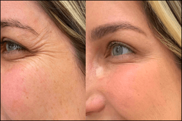 Skin concerns before treatment – wrinkles, dark spots, uneven texture