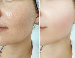 Collagen Mask Vellura